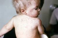 Centers for Disease Control photo of a child with measles. 